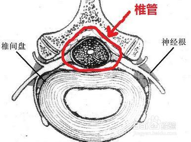 椎管狭窄是怎么造成的图片